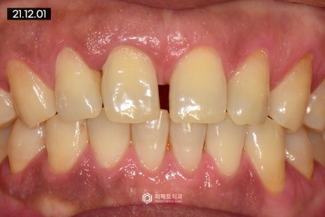 벌어진 앞니, 레진으로 치료 가능? 관련 이미지 4