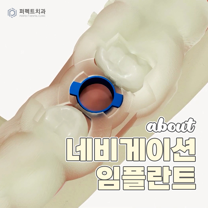 네비게이션 임플란트란? 관련 이미지 1