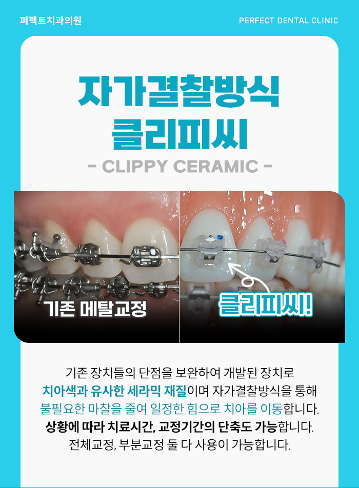 치아교정, 치료 시 참고사항은? 관련 이미지 8