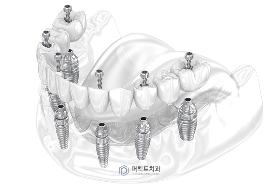 임플란트 후 나타날 수 있는 부작용은?② 관련 이미지 1
