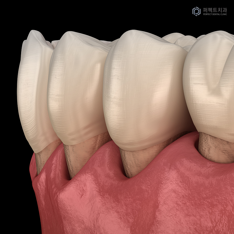 교정 후 잇몸퇴축은 흔하게 생기나요? 관련 이미지 5