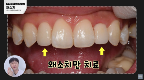 작은치아 왜소치 라미네이트 과정 공개! 관련 이미지 4