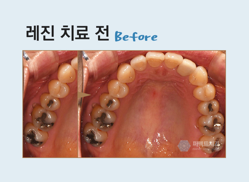 레진필링으로 벌어진 치아 메꾸자 관련 이미지 7