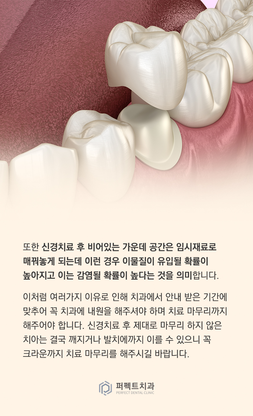 신경치료 후 크라운이 꼭 필요한 이유는? 관련 이미지 4