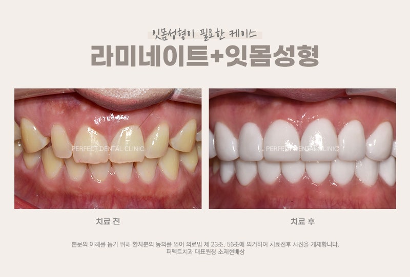 라미네이트시 잇몸성형 해야되나요? 관련 이미지 2
