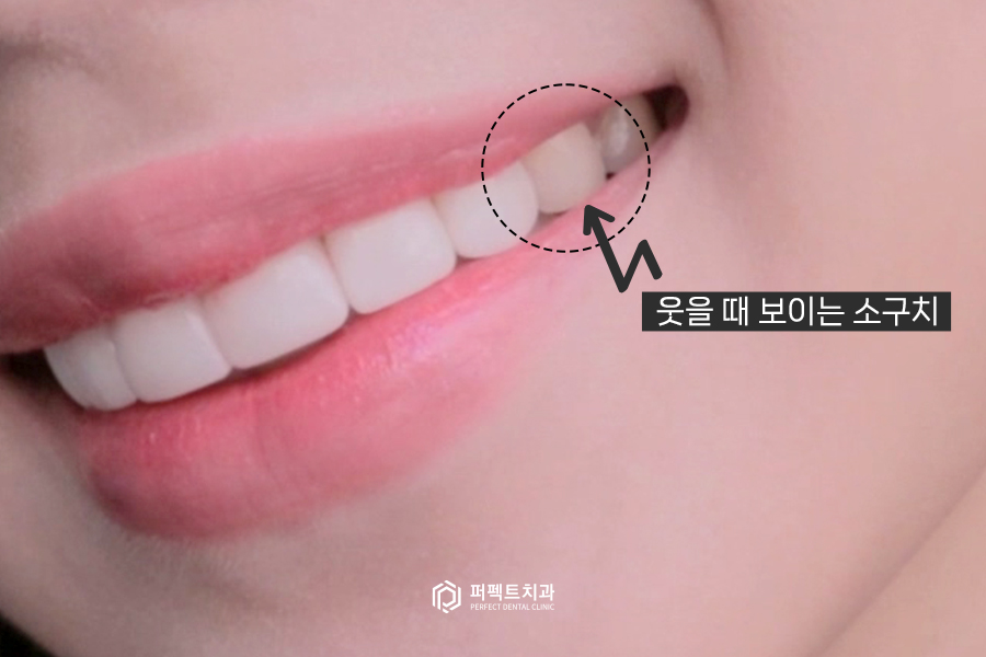 6년 전 라미네이트 교체&연장, 그 이유는?😯 관련 이미지 5