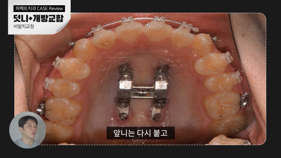 덧니+개방교합, MARPE를 이용한 비발치교정 관련 이미지 8