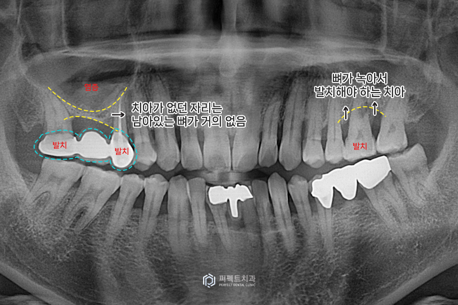 임플란트를 해야하는데 상악동에 염증이..😭 관련 이미지 2