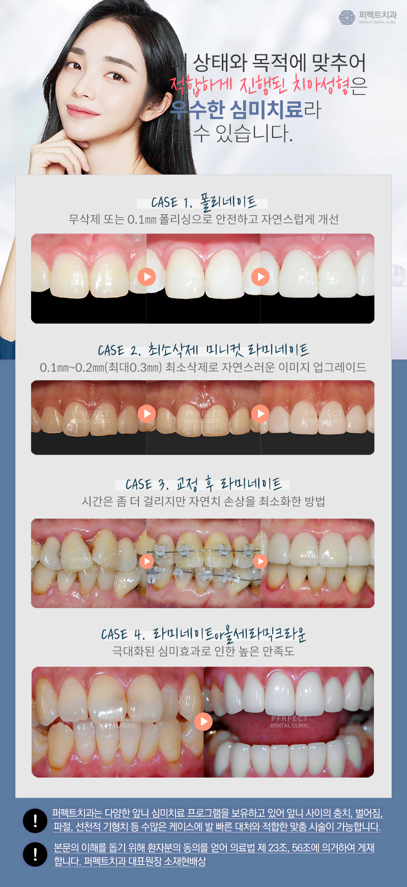 앞니라미네이트 퍼펙트한 비용 확인하기! 관련 이미지 3