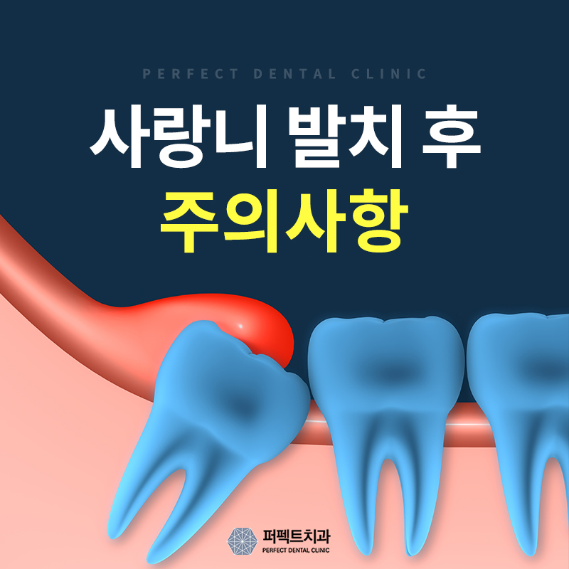 사랑니 발치 후 주의사항은? 관련 이미지 1