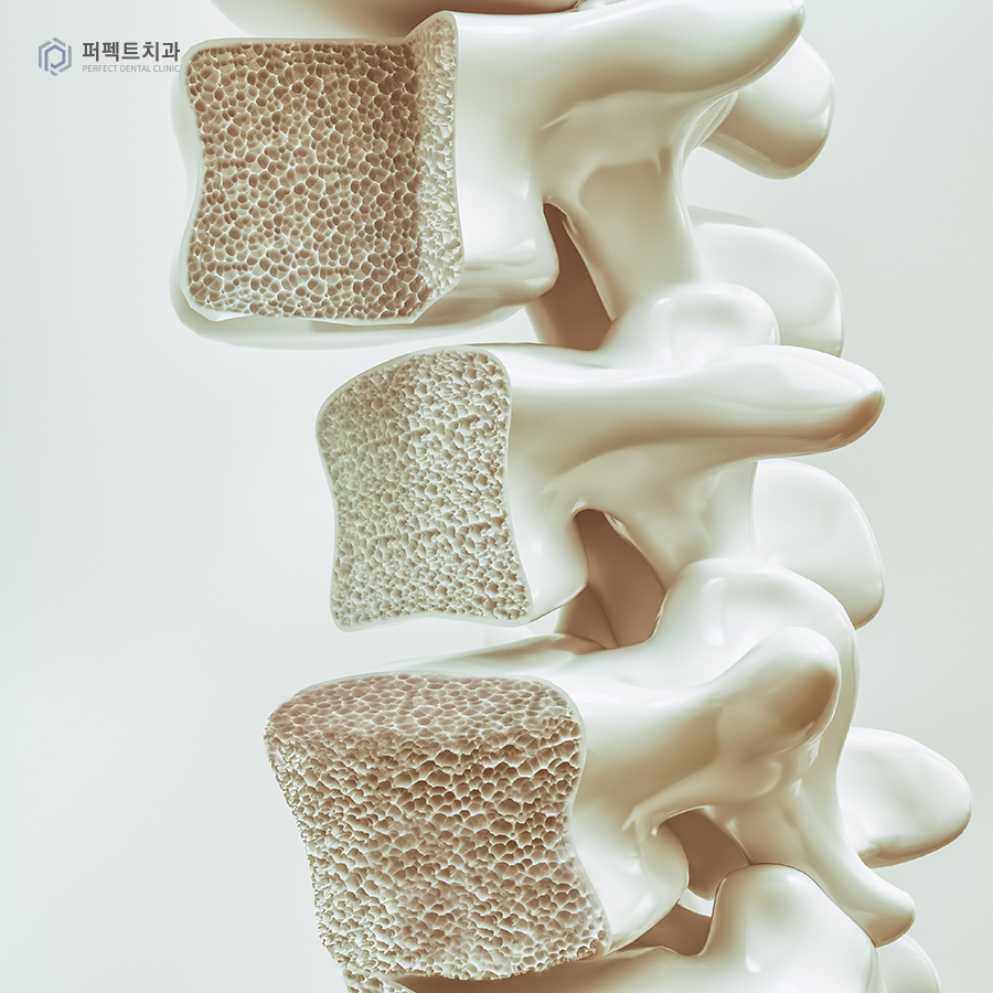 임플란트 부작용, 어떤 경우에 주의해야 할까? 관련 이미지 3