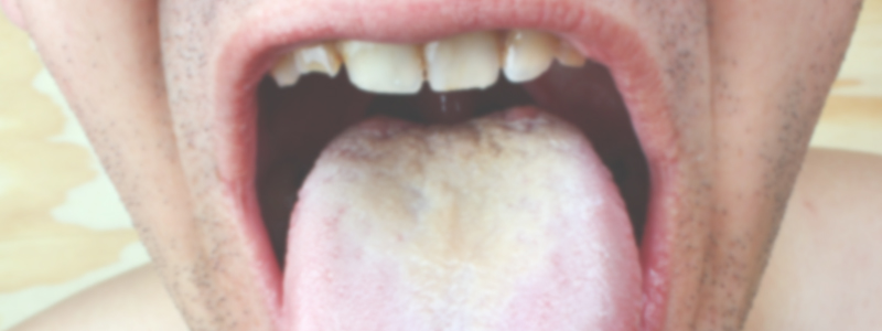 혓마닥에 설태가 생기는 이유 관련 이미지 2