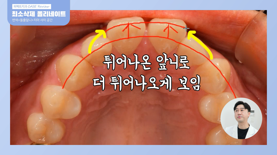 앞니 돌출,벌어짐,변색.. 교정이 싫다면 이 방법으로!? 관련 이미지 5
