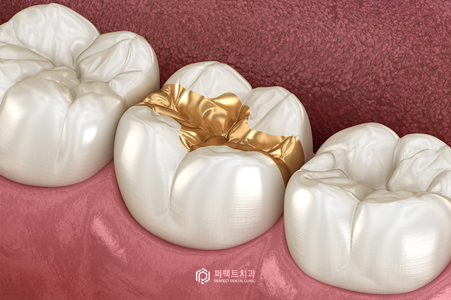 중기충치 관련 이미지 1