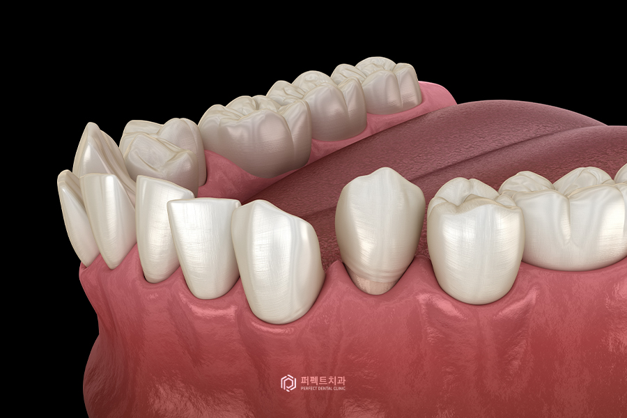 발치교정 한 부분에 틈이 벌어질 수 있을까요..? 관련 이미지 1