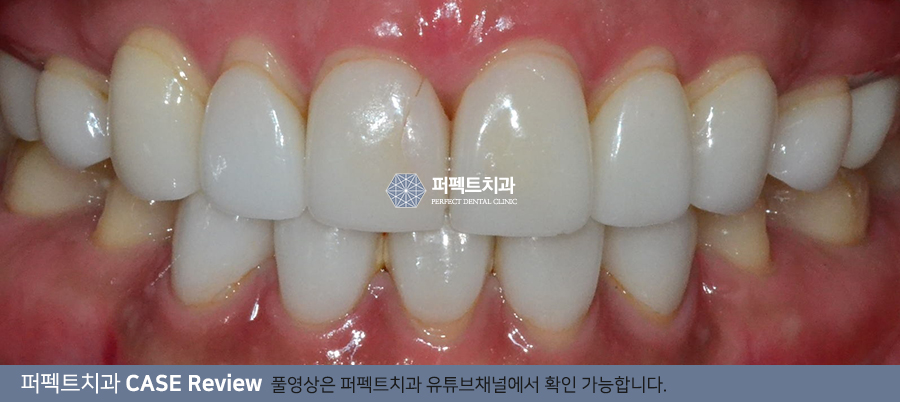 오래된 라미네이트 재시술, 보철물 교체 (잇몸노출,변색) 관련 이미지 2
