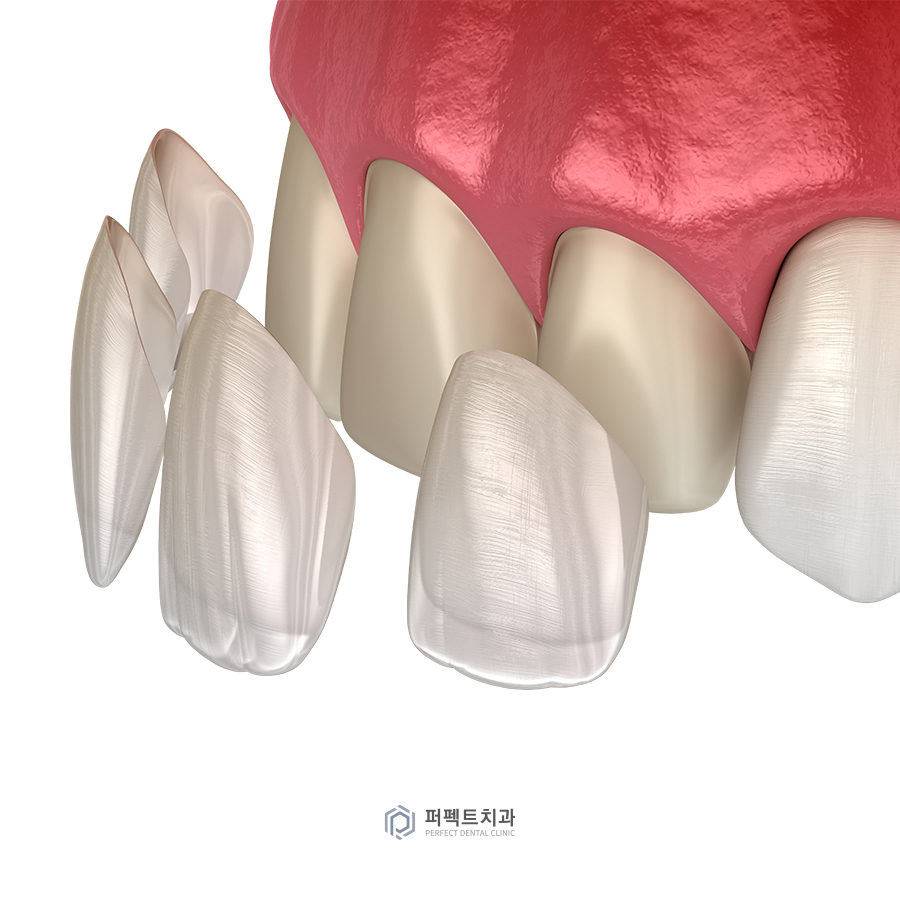 라미네이트 후 교정 유지장치는? 관련 이미지 2