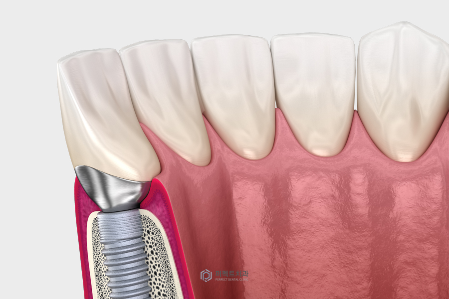 임플란트 시 꼭 뼈이식을 해야할까? 관련 이미지 3