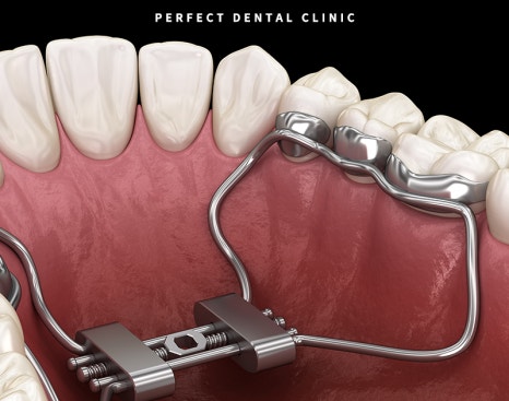 MARPE 악궁확장장치로 위턱 넓히기?! 관련 이미지 2