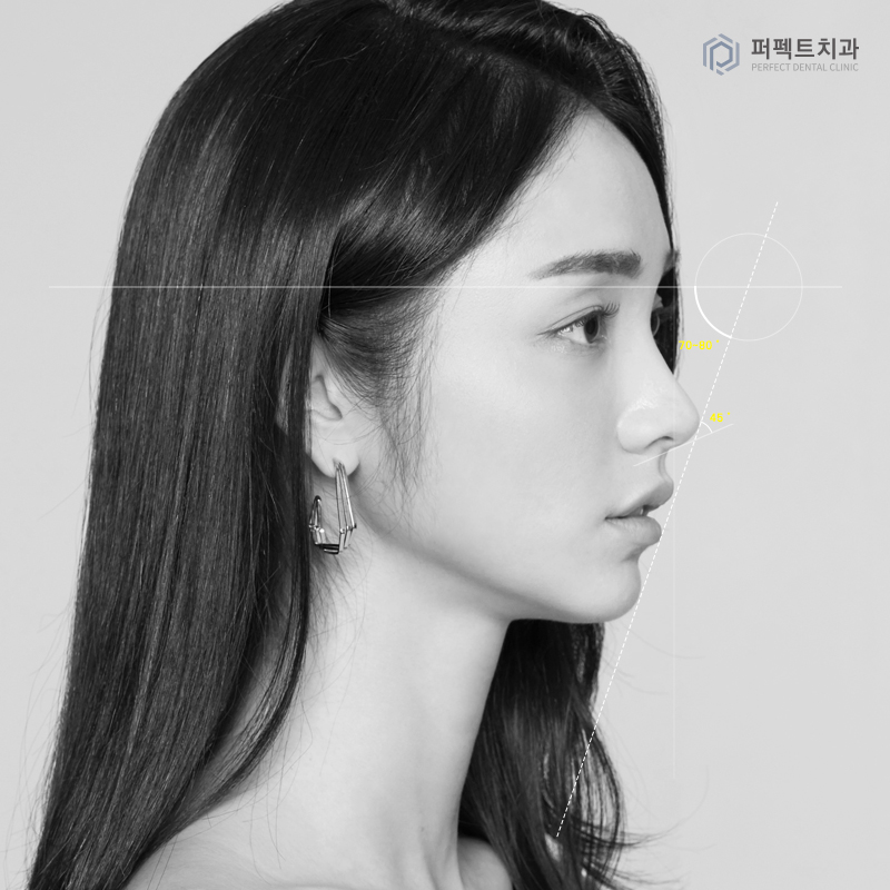 치아교정 중 코성형 해도 될까요? 관련 이미지 1