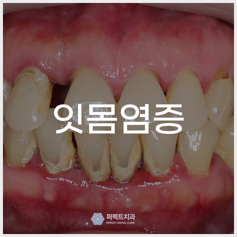 잇몸염증 증상과 좋은 음식 관련 이미지 1
