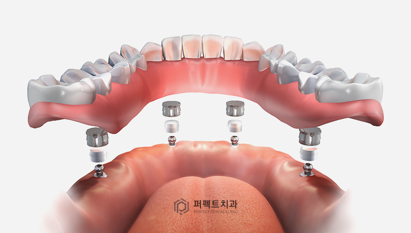 컴퓨터 분석을 통한 임플란트 관련 이미지 3