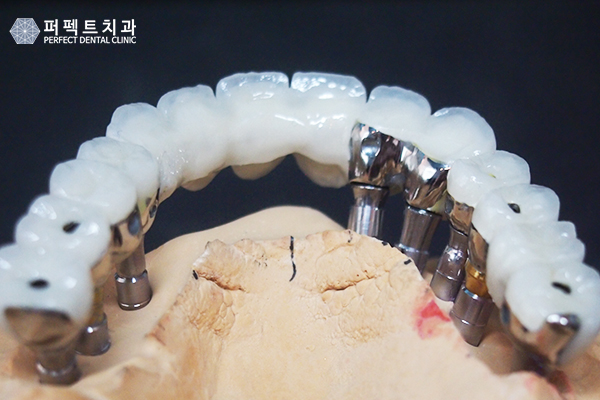 임플란트 건강보험 적용하면? 관련 이미지 6