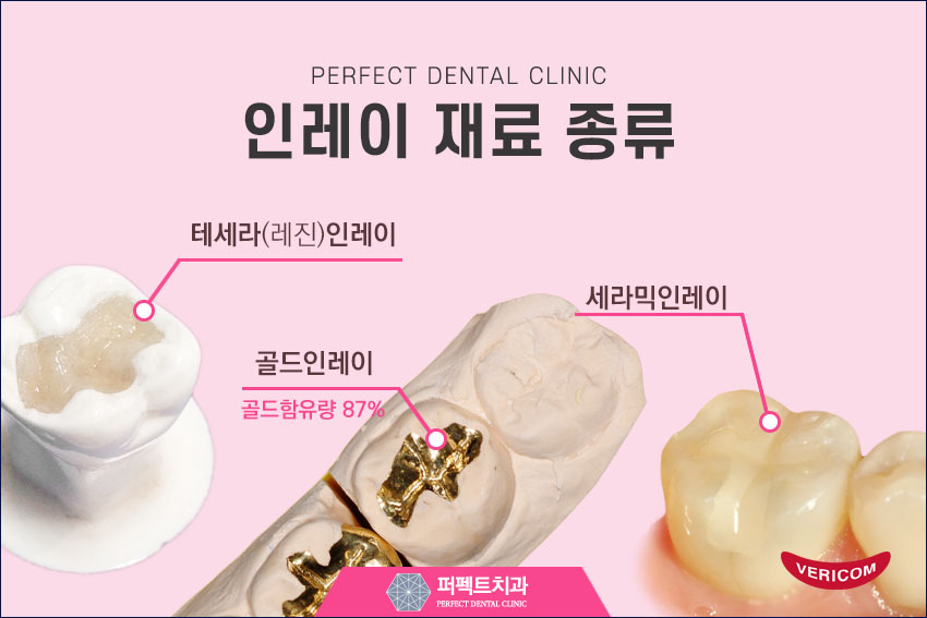 세라믹인레이 충치치료 비용 관련 이미지 2