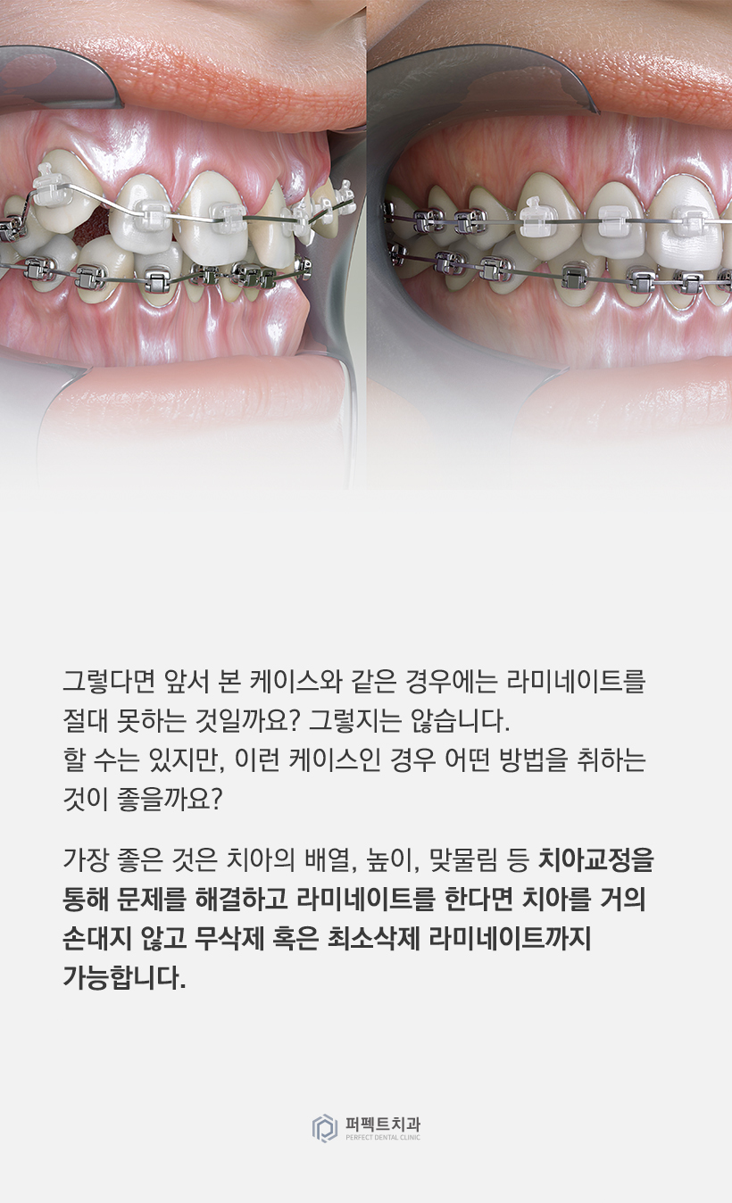 어떤 경우에 라미네이트를 하면 안되나요? 관련 이미지 4