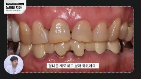노화된 치아, 최소삭제라미네이트 관련 이미지 2