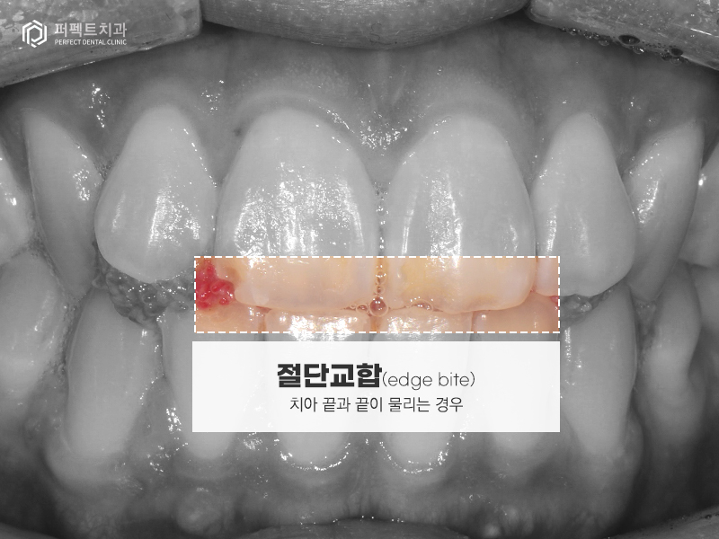 남자라미네이트, 폴리네이트 두가지 케이스 관련 이미지 2
