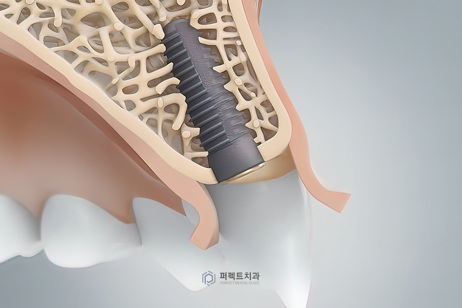 임플란트 종류|좋은 임플란트 고르는 방법은? 관련 이미지 2