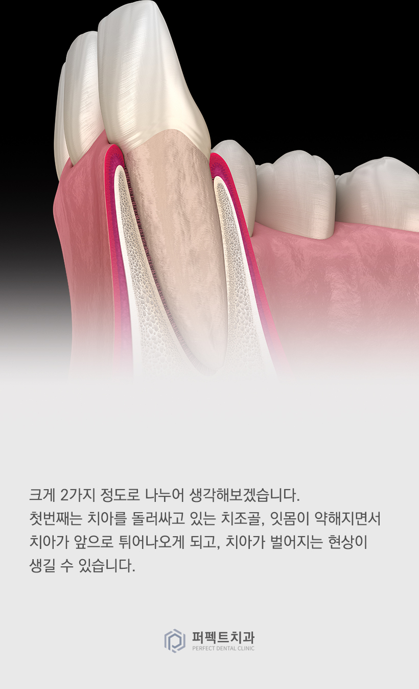 라미네이트를 했는데 앞니가 벌어졌어요! 관련 이미지 2
