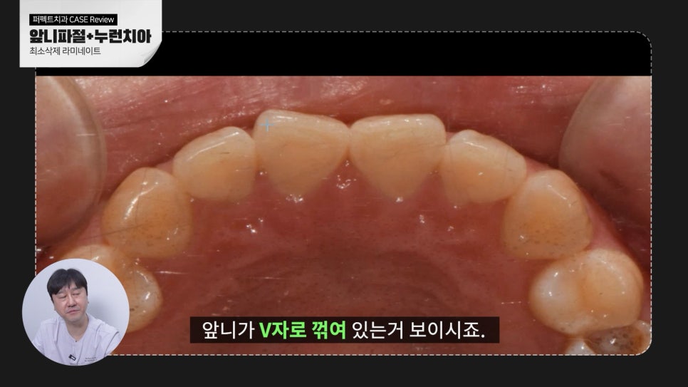 깨진앞니+나비치아 무삭제라미네이트 관련 이미지 4