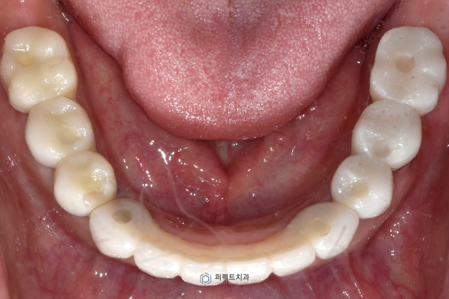살릴 수 있는 치아가 없다면?❌｜전체임플란트 수복 관련 이미지 12