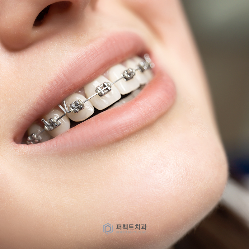 턱관절 안 좋은데 치아교정 가능할까요? 관련 이미지 3