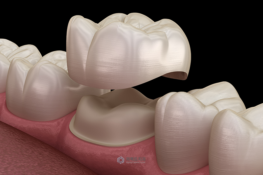 치아에 금이 갔어요|예방법과 치료방법은? 관련 이미지 2