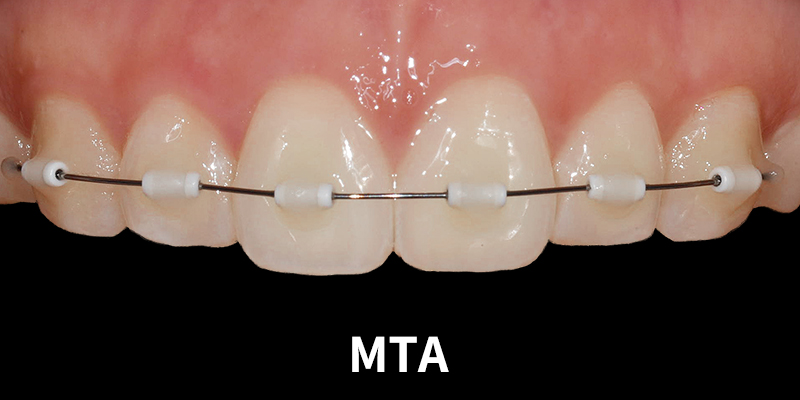 MTA부분교정으로 단기간 교정끝내기 관련 이미지 2