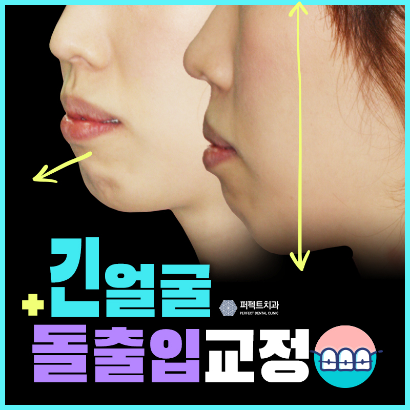 긴얼굴교정 수술없이 해결! 관련 이미지 1