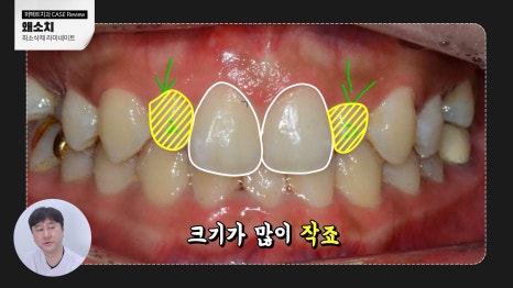 주변 치아보다 작은 관련 이미지 2