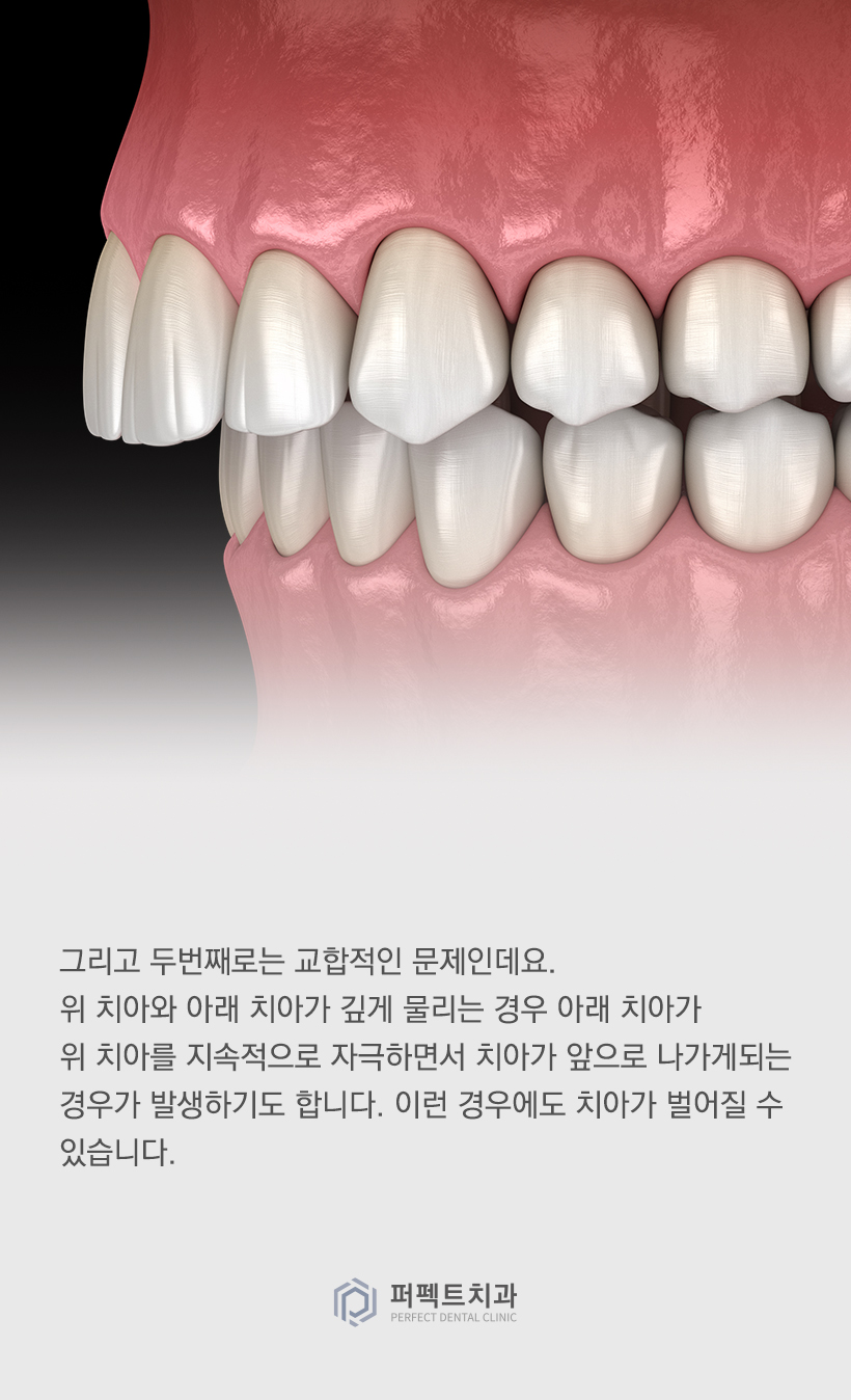 라미네이트를 했는데 앞니가 벌어졌어요! 관련 이미지 3