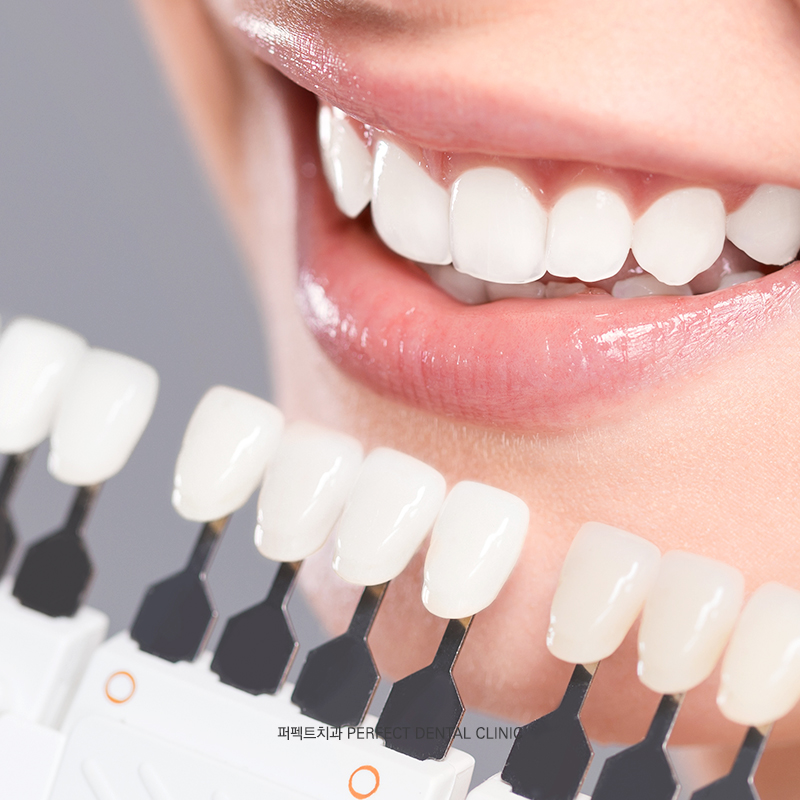 라미네이트도 변색, 착색이 되나요? 관련 이미지 3