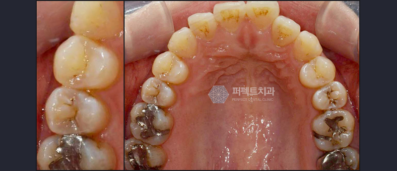 선릉 충치치료 인레이 알아보기! 관련 이미지 3