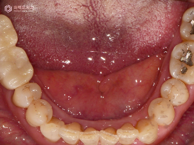 장거리+다수의 임플란트 케이스 관련 이미지 10