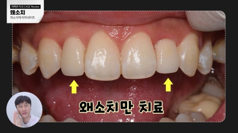 주변 치아보다 작은 관련 이미지 8