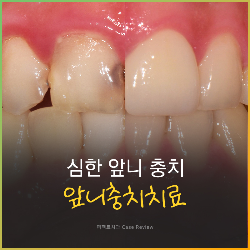 레진치료 불가능한 심한 앞니 충치, 이렇게 변했어요! 관련 이미지 1