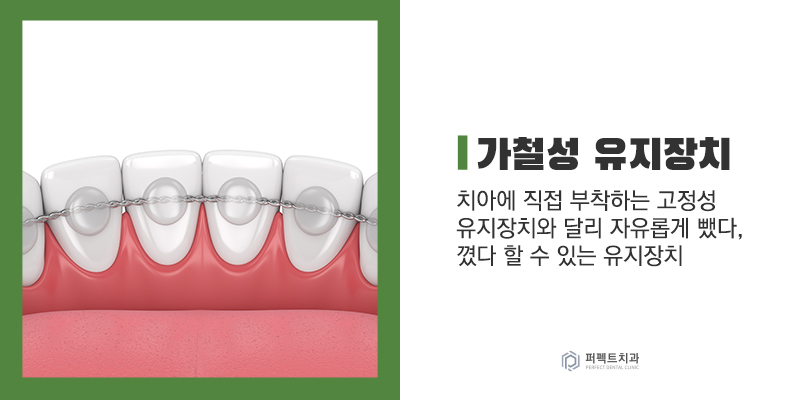 교정 후 라미네이트, 유지장치는? 관련 이미지 3