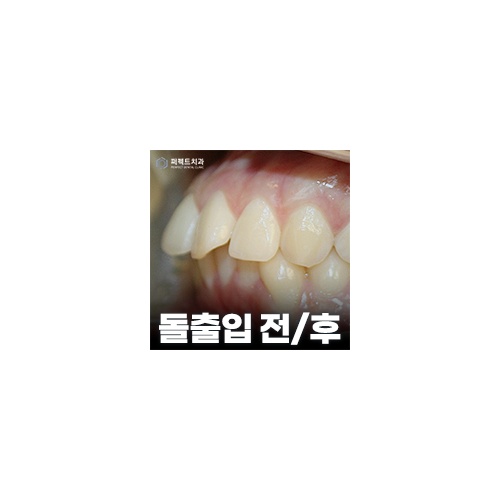 돌출입교정 후기 및 비용은? 관련 이미지 3
