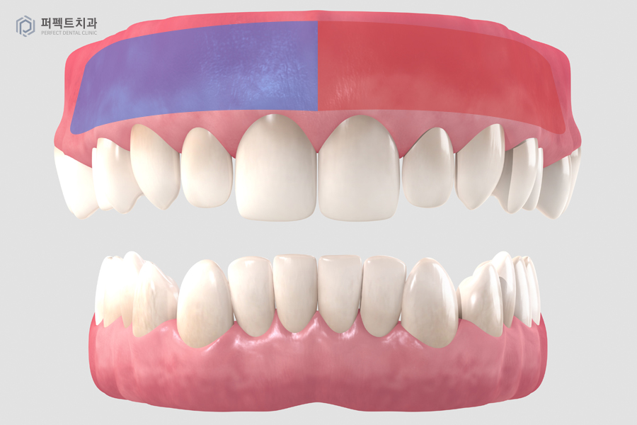 악궁확장장치 MARPE, 사용하는 이유는? 관련 이미지 4