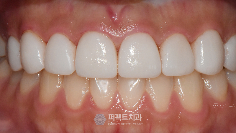 라미네이트 부작용 왜 나타나는 건가요? 관련 이미지 5